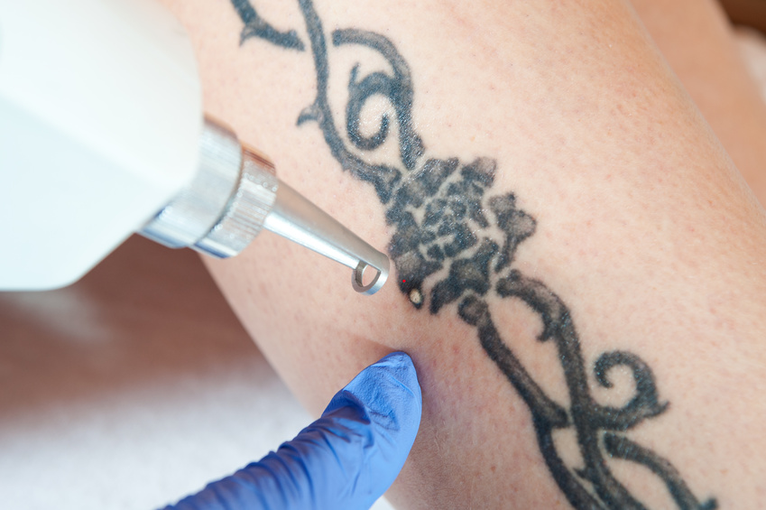 tattoo removal methods