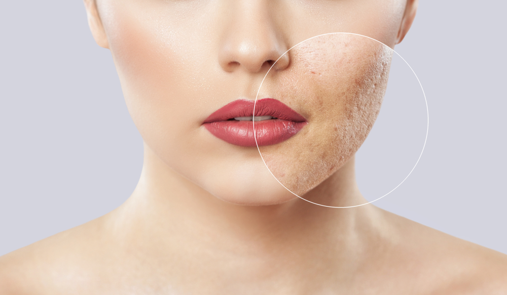 How Do Lasers Treat Acne and Acne Scars?
