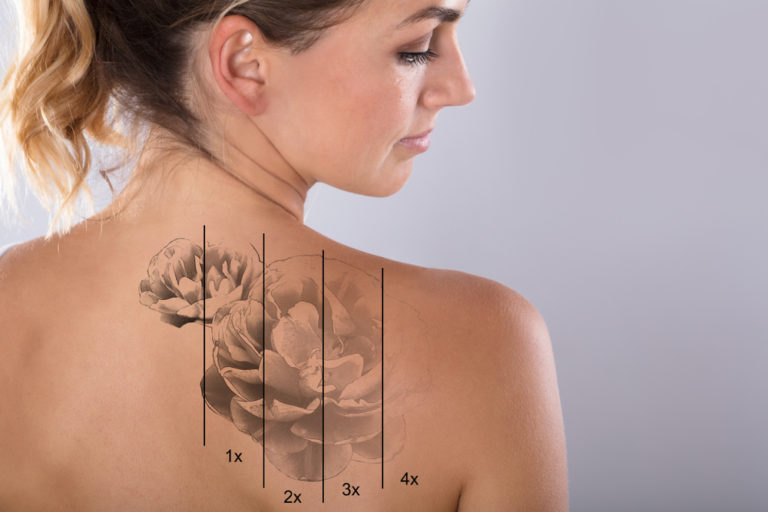 How Do I Find the Best Tattoo Removal Specialist Near Me?