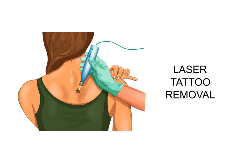 Is Tattoo Removal Permanent