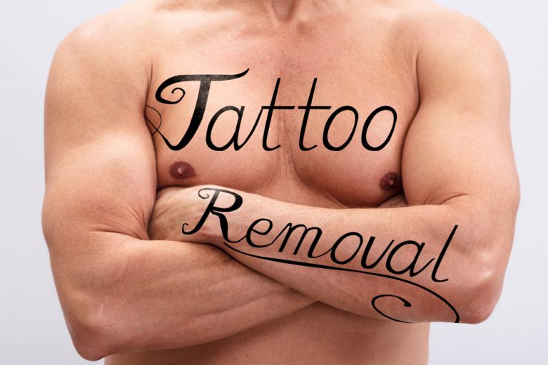 Laser Tattoo Removal in Loudoun County