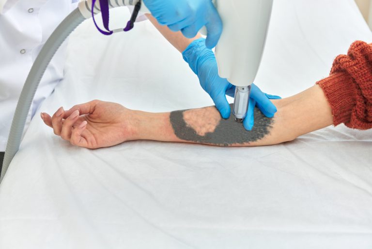 Your Quick Guide to Laser Tattoo Removal in Ashburn Virginia