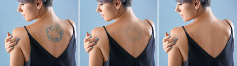4 Things You Should Know About Tattoo Removal in Leesburg
