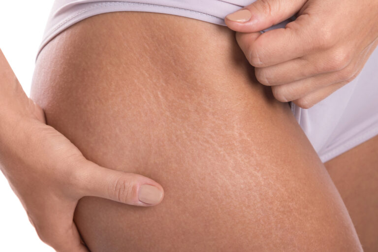 Stretch Mark Reduction in Herndon