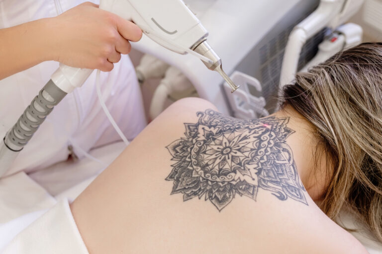 Best PicoWay vs. PicoSure Tattoo Laser Pricing