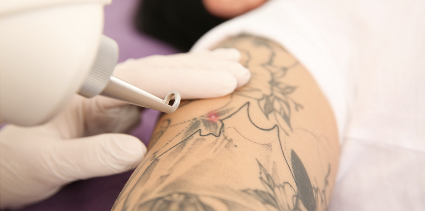 What is the best way to improve laser tattoo removal process and fading  Massage Scar gel  Quora