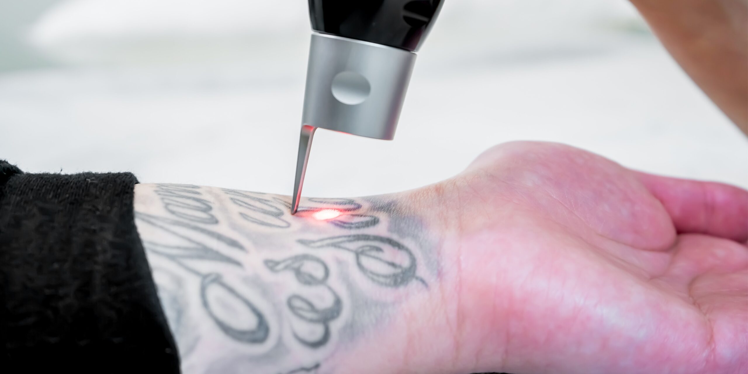 Not so permanent tattoos — Tailored Tattoo Removal Melbourne