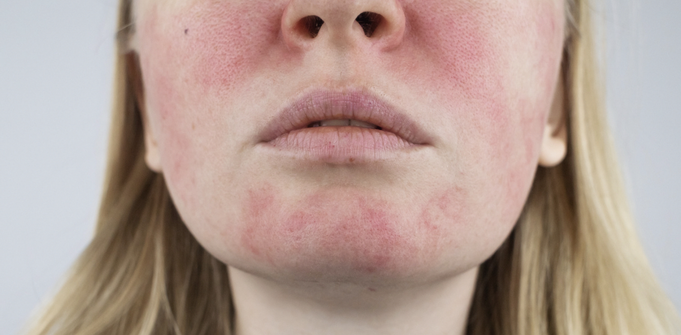 rosacea treatments