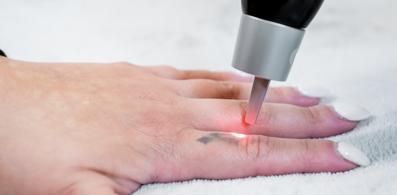 Best Tattoo Removal Lasers in Virginia