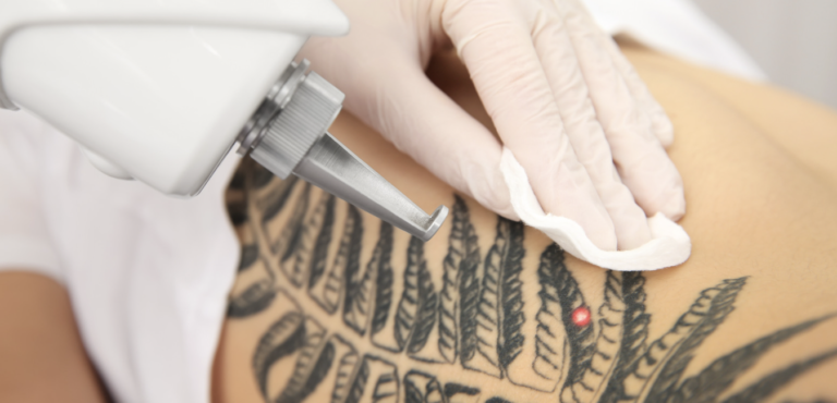 is Tattoo Removal permanent