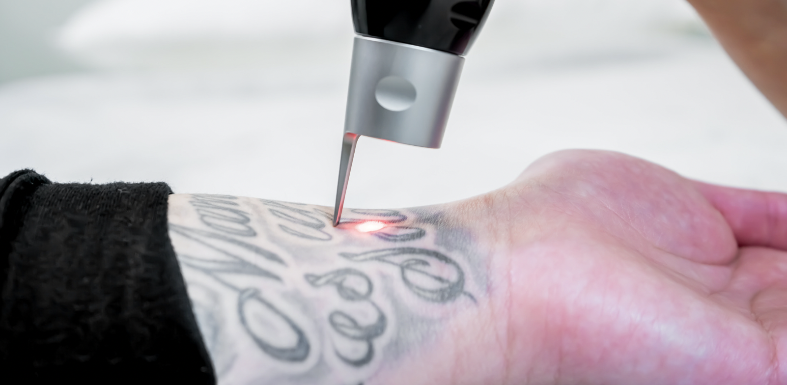 Best Laser Tattoo Removal Treatments