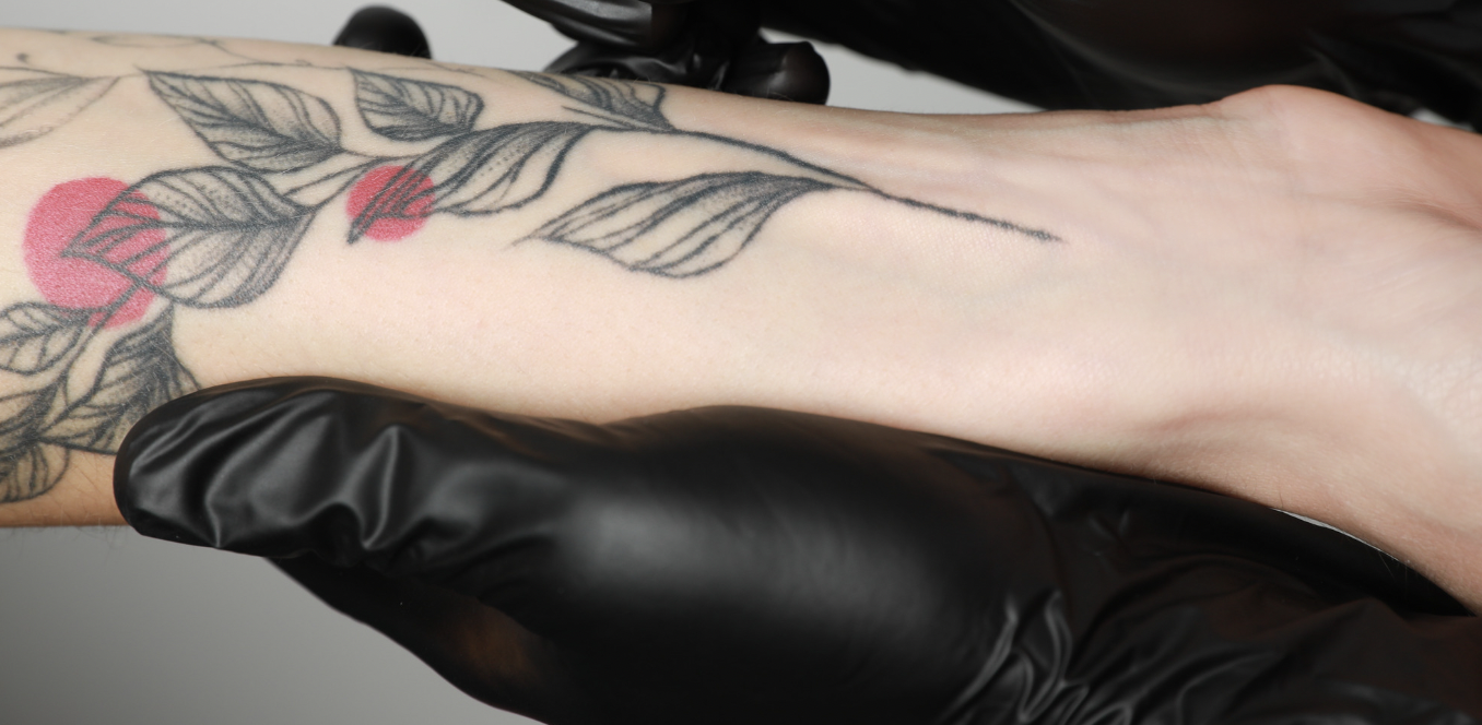 Are Permanent Tattoo Removal Results Worth the Cost