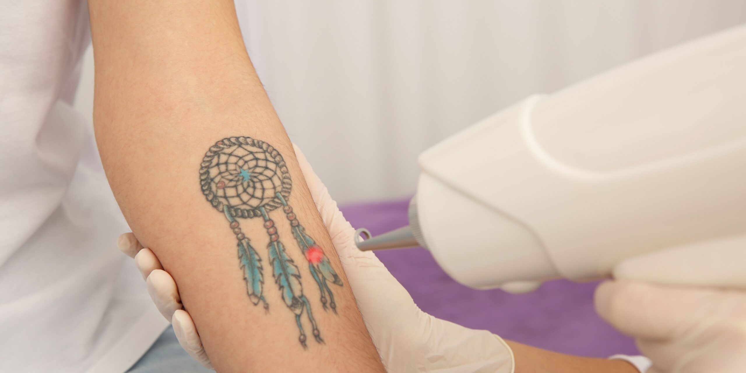 Laser Tattoo Removal Services in Leesburg