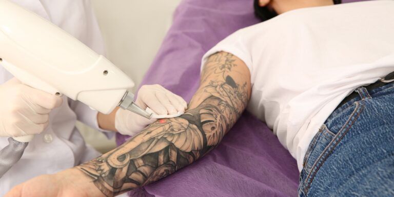 Best Laser Tattoo Removal Clinic in Arlington