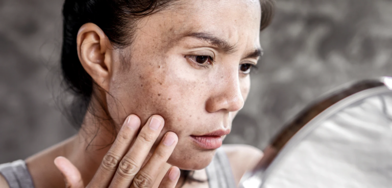 Melasma Treatment Options in Reston