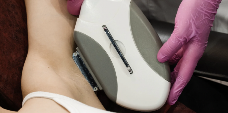 How Laser Hair Removal Works