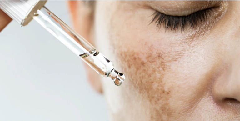 Best Melasma Specialist in Reston Virginia