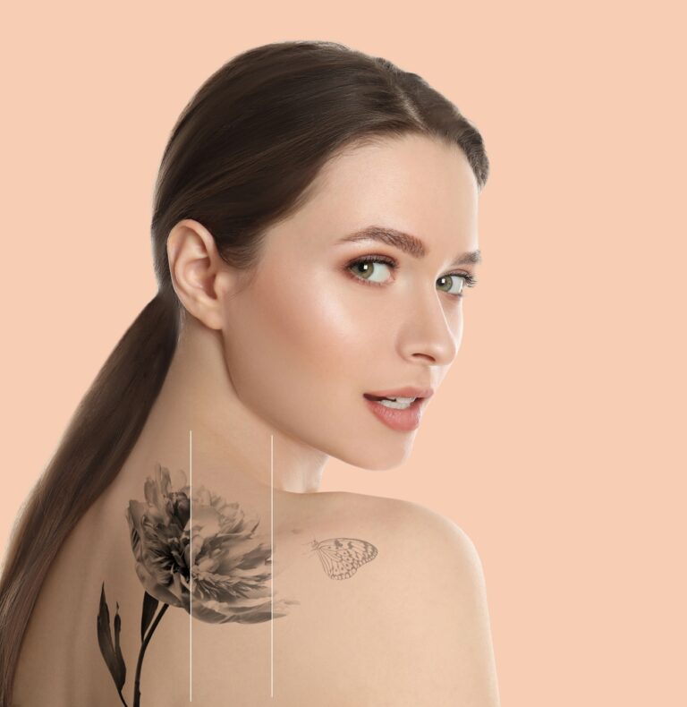 Woodbridge Virginia Tattoo Removal Pricing