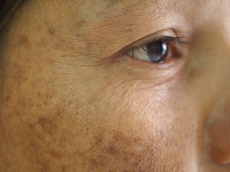 Expert Melasma Treatment Near Lansdowne