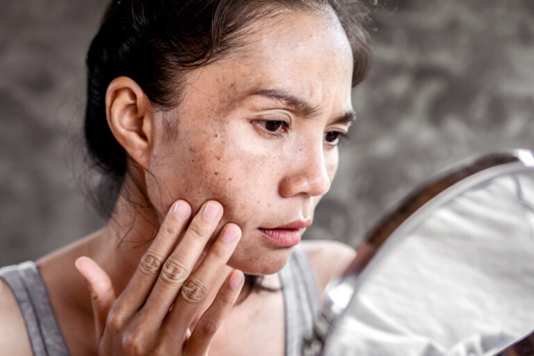Finding the Right Melasma Specialist Near Purcellville VA