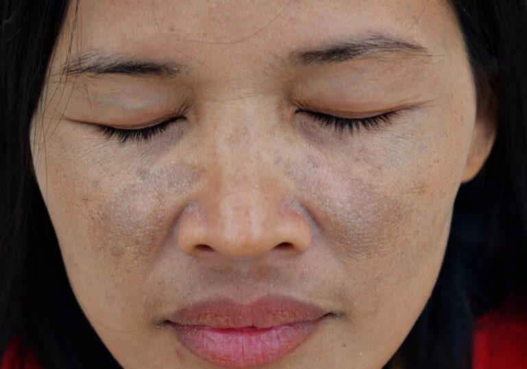 Comprehensive Guide to Effective Melasma Treatments Available Near Reston