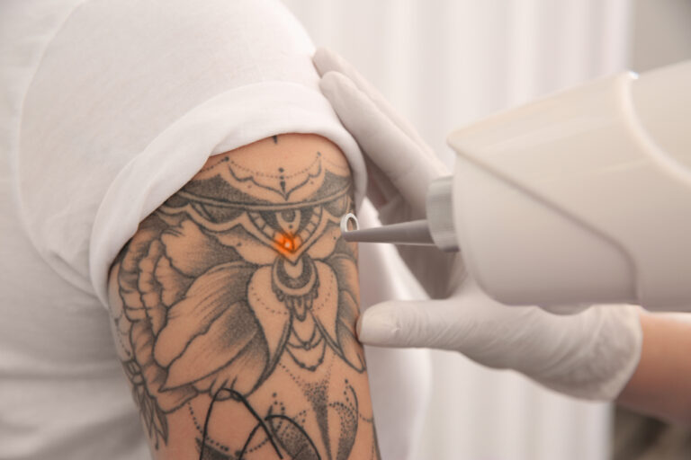 How Much Does Tattoo Removal Cost in Alexandria, Virginia?
