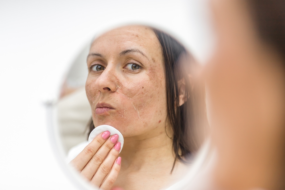 Where to Get Expert Melasma Care Near South Riding, Virginia for Lasting Results