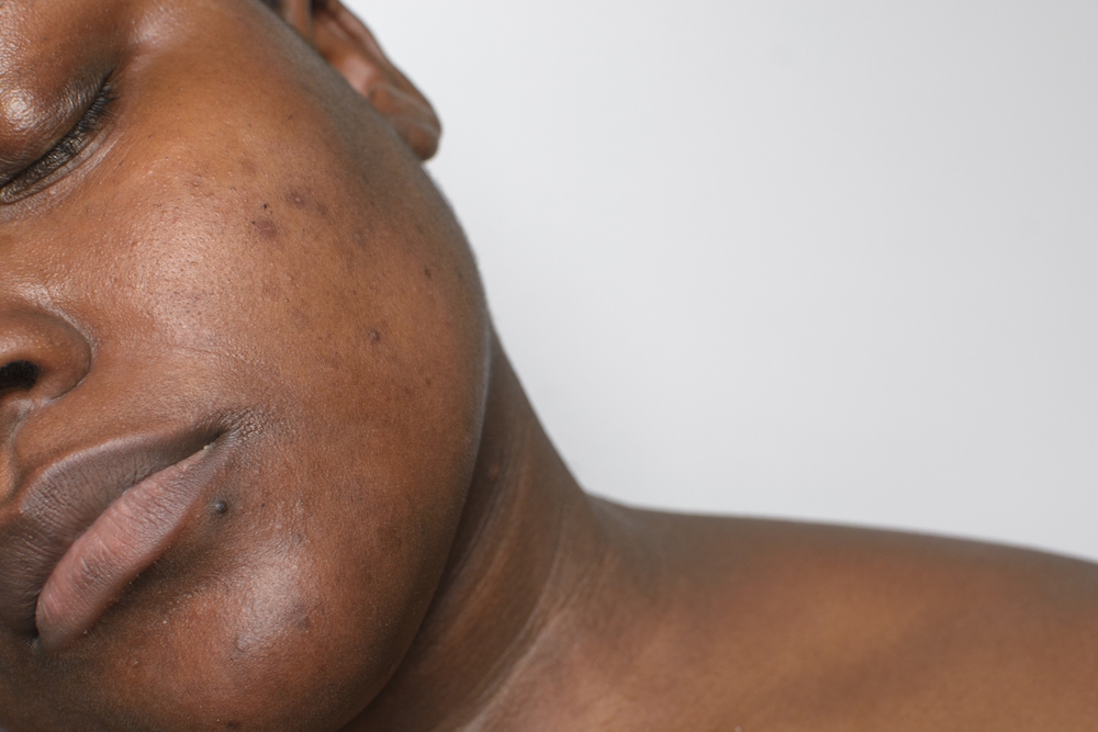Top Hyperpigmentation Specialists in Reston VA