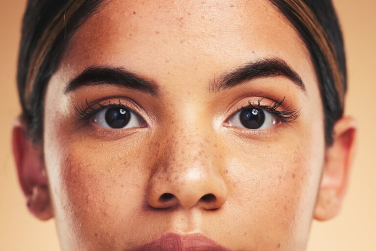 Top-Rated Melasma Treatments Near Leesburg, Virginia and What to Look For in a Specialist