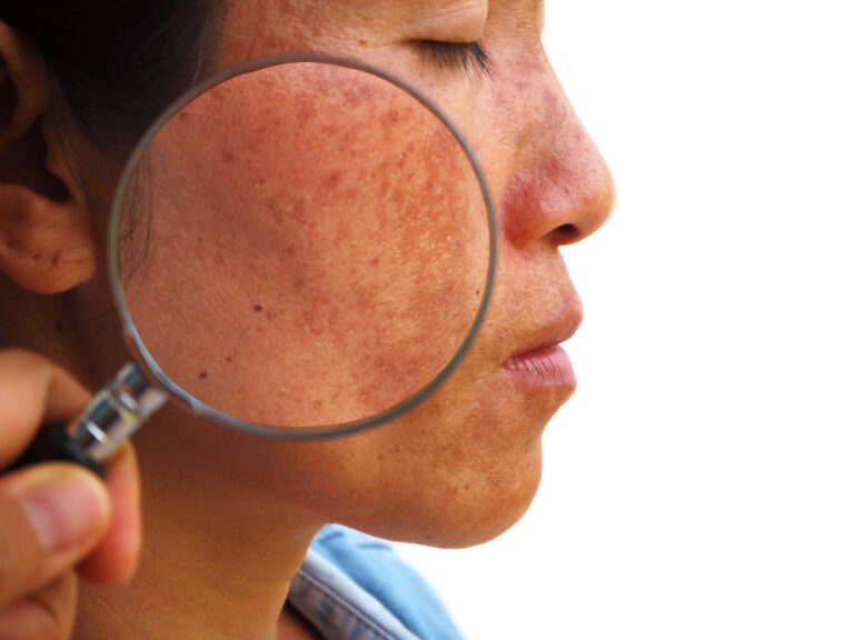 5 Ways You Know You've Found the Top Melasma Specialist Near Arlington, VA