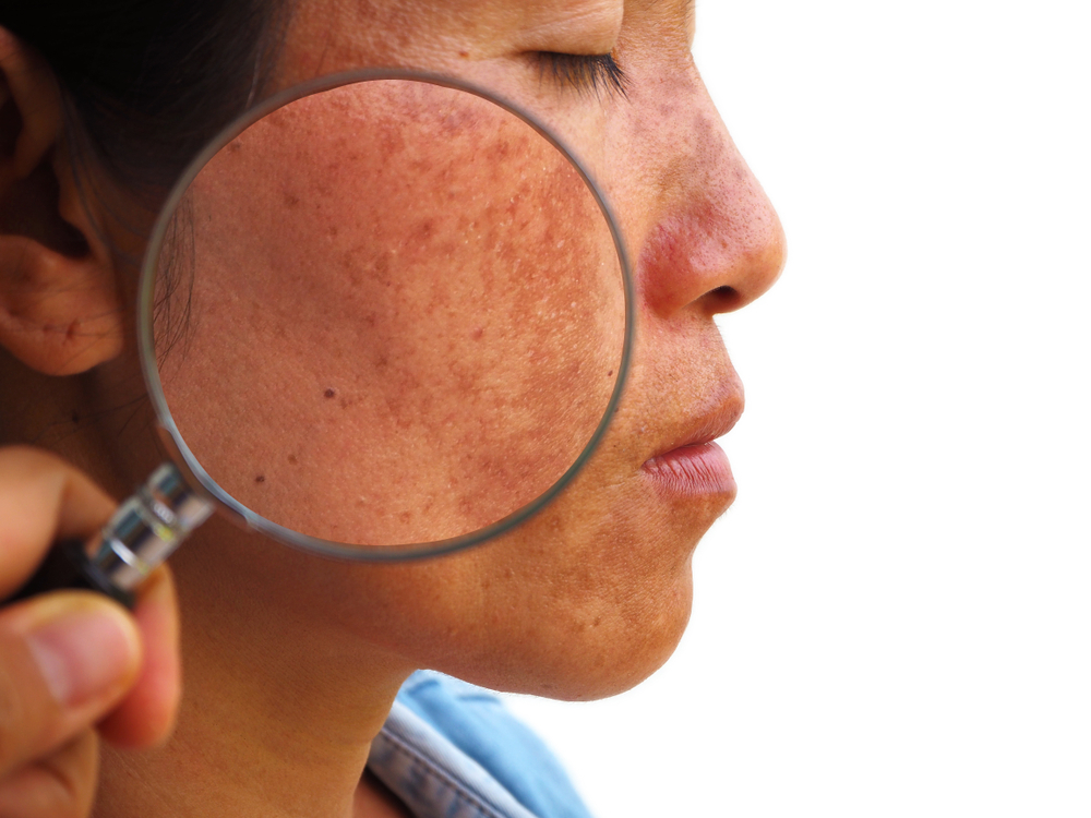 5 Ways You Know You've Found the Top Melasma Specialist Near Arlington, VA