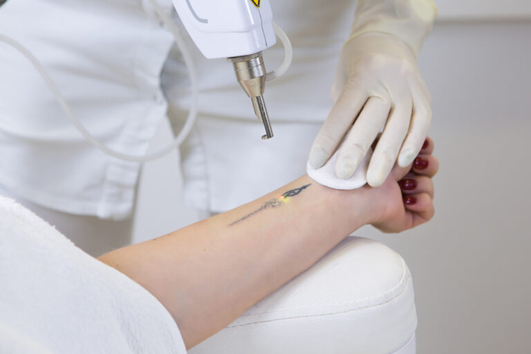 Tattoo Removal Pricing Near Loudoun County: What You Should Know