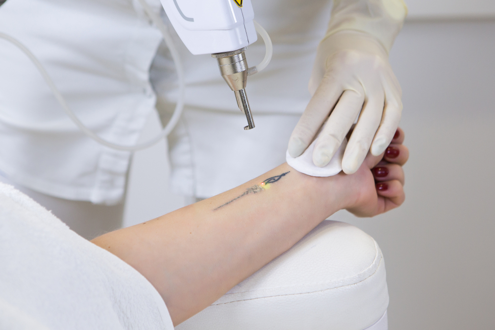 Tattoo Removal Pricing Near Loudoun County: What You Should Know
