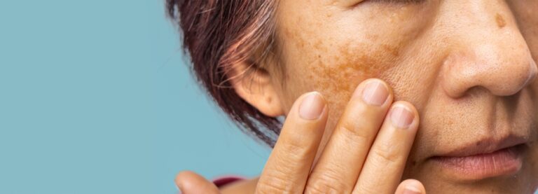 Melasma Treatment Options Near Alexandria, VA That Actually Work