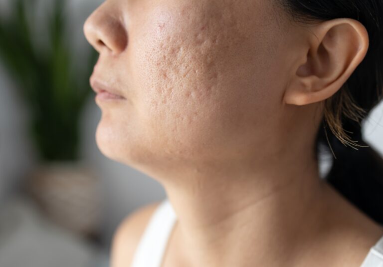 Choosing the Top Clinic for Pico Laser Acne Scar Treatments Near Fairfax, VA Made Simple