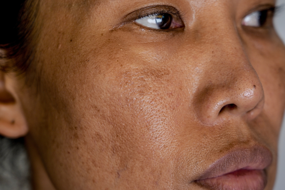 Tattoo Removal Pricing Near Loudoun County: What You Should Know