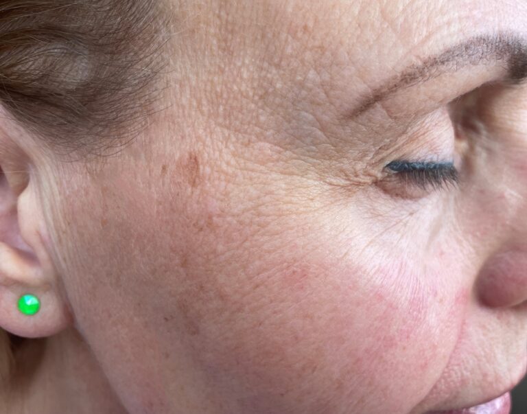Pico Laser for Pigmentation Removal Near Arlington