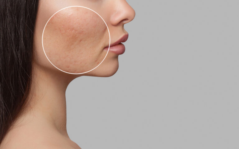 Laser Resurfacing vs. Microneedling for Acne Scars: What Works Best