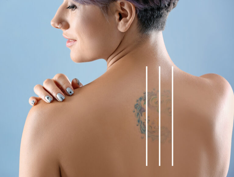 Breaking Down Tattoo Removal Sessions & Costs in Burke & Centreville Clinics