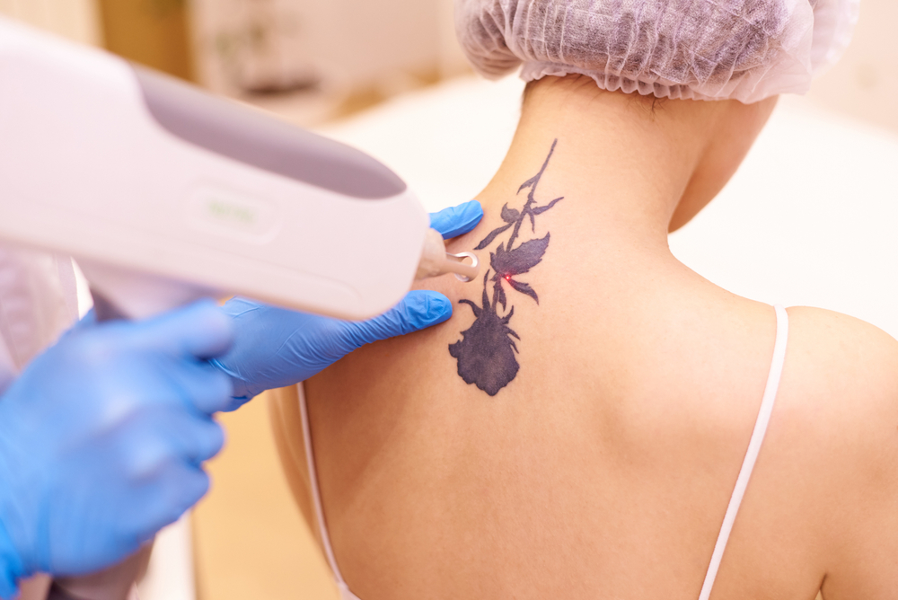 What to Expect with Tattoo Removal Cost Estimates in Arlington & Alexandria