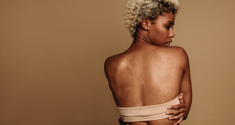 Safe Laser Options for Melanin-Rich Skin in Reston & Leesburg Clinics