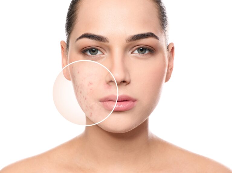 Top Acne Specialists Serving Ashburn & Sterling: What to Look For