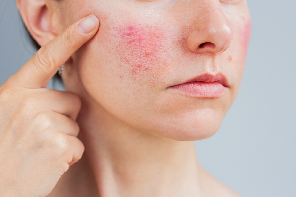 Laser and IPL Acne Treatments in Ashburn and Herndon: Are They Right for Your Skin?