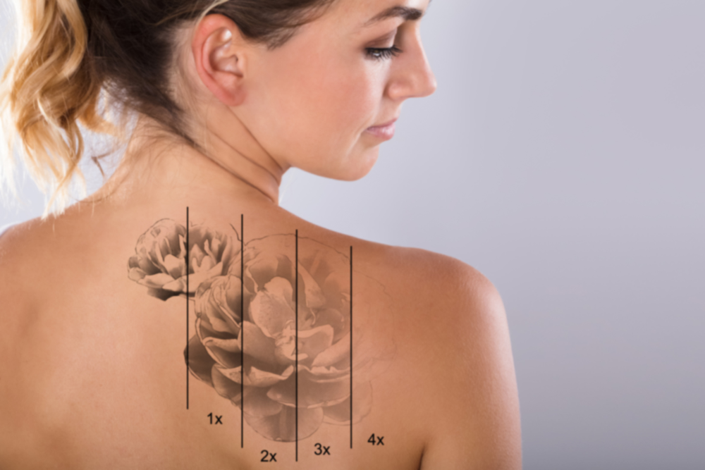 Permanent Tattoo Removal Consultation Near Tysons Corner, Virginia