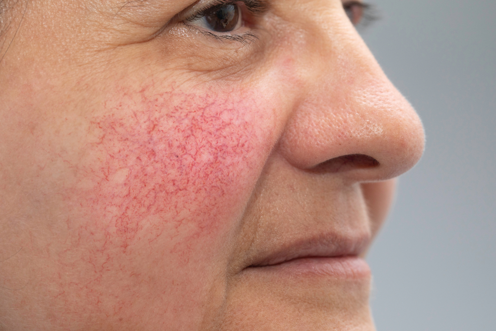 IPL for Rosacea and Redness in Northern Virginia: How Many Treatments Are Required