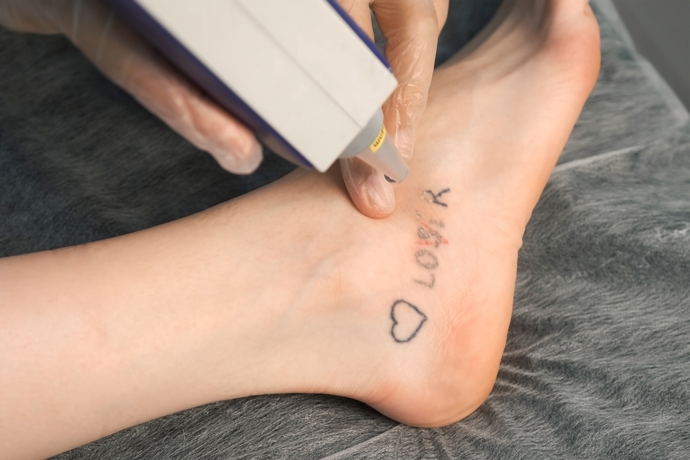 Tattoo Removal in Northern Virginia Using Pico Laser