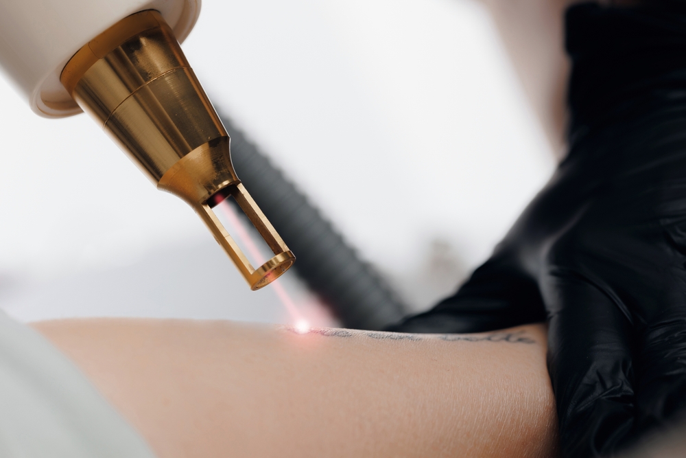 Tattoo Removal Cost in Northern Virginia Comparing Pico Laser vs. Traditional Laser