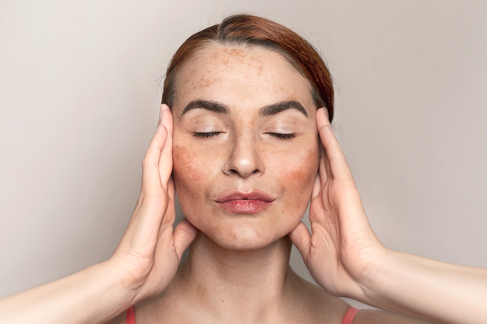 #1 Best Laser Treatment for Melasma in Fairfax and Northern Virginia: What Actually Works