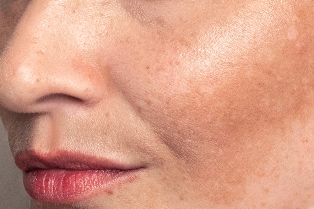 Best Pico Laser Treatment for Melasma in Northern Virginia: What Patients Should Know