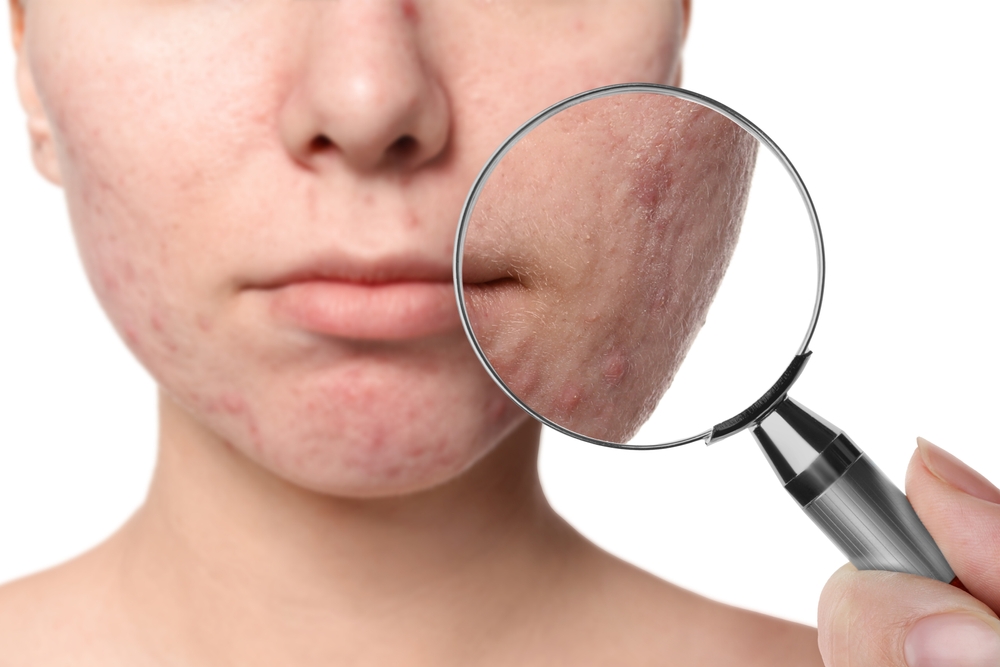 Pico Laser Acne Scar Treatment Near Leesburg, Virginia: Before and After Results Explained